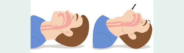 Baş geri - çene yukarı pozisyonu: Hava yolunu açmak için doğru pozisyon tekniği